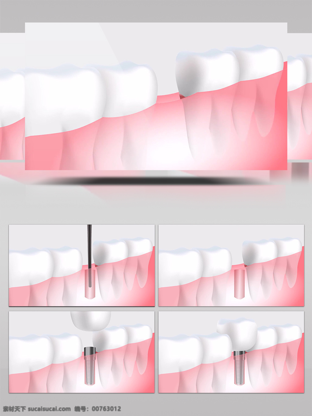 医疗 种 牙 补牙 三维 视频 3d 牙科 牙医