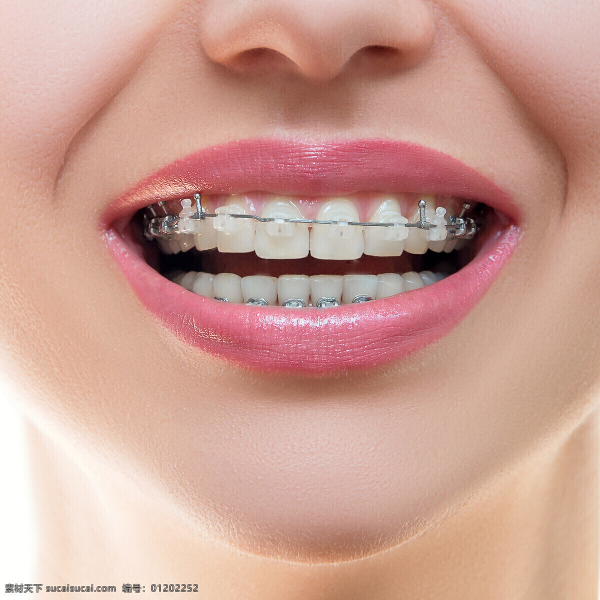 医学美容正牙 牙齿 牙科 医学 美容 正牙 钢丝 现代科技 医疗护理