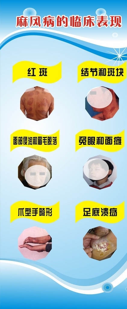 麻风病 x展架 红斑 斑块 面部 脱落 足底等 展板模板 矢量