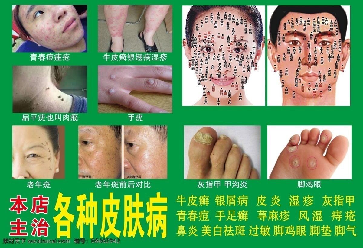 主治 皮肤病 荨麻疹 点痣 去猴子 痦子 瘊子 脚气 脚痒 鸡眼 雀斑 祛斑 祛痘
