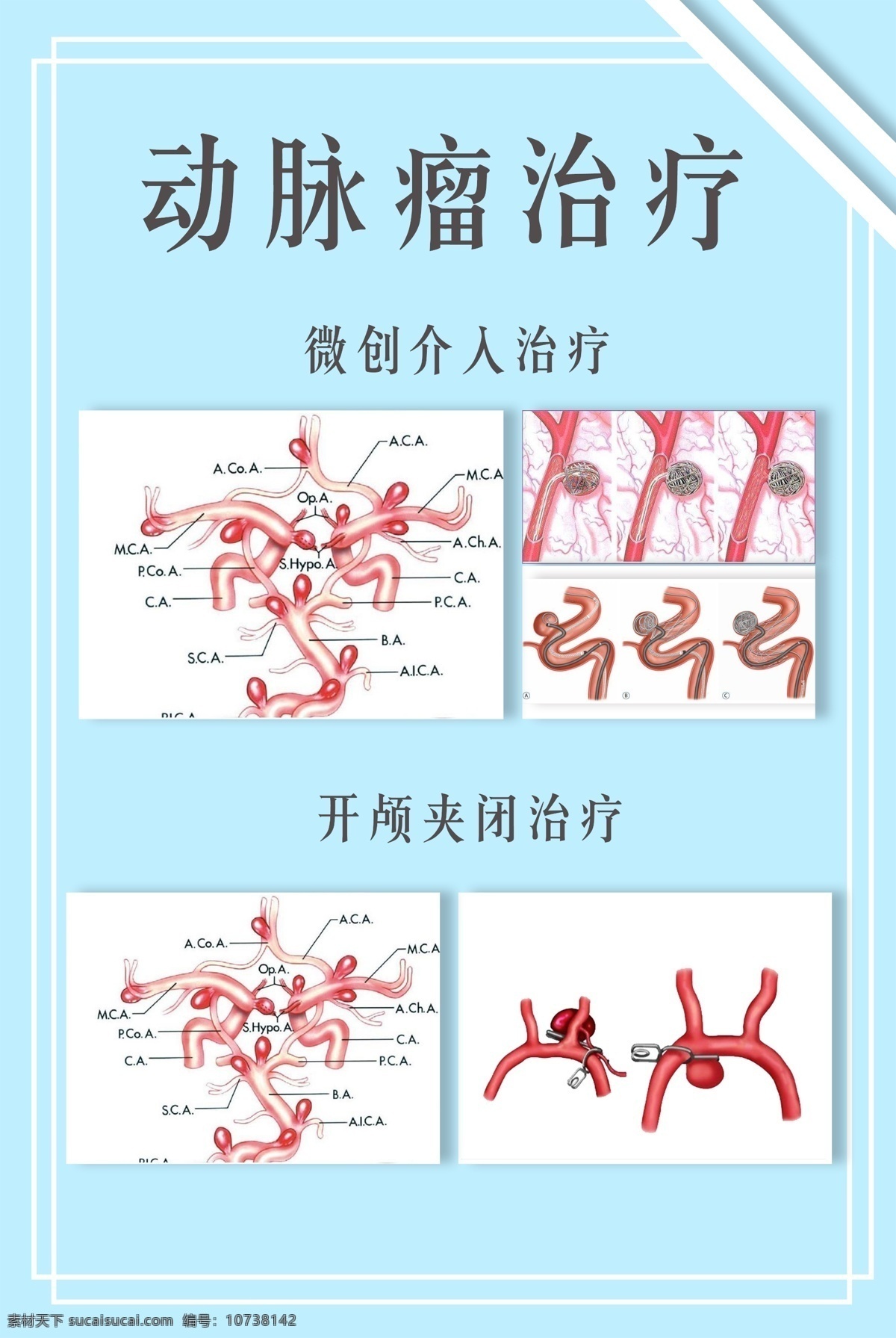 动脉瘤 治疗 图谱 微创介入 开颅夹闭 医学图谱