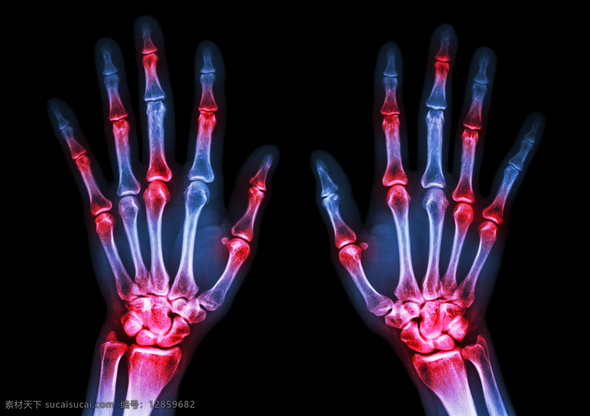 手部x光片 手部 手掌 x光 透视 医疗 ct x光片 核磁共振 医疗护理 现代科技